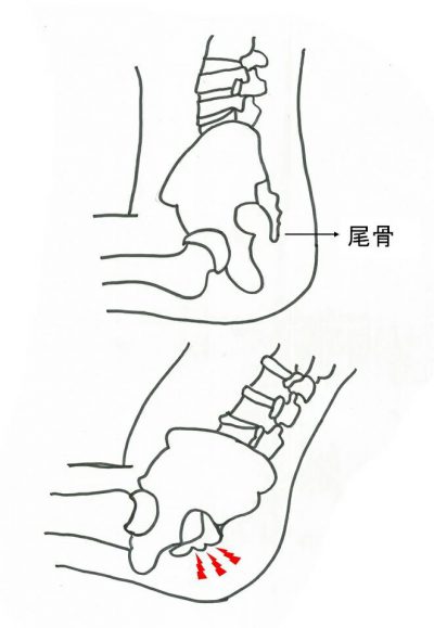 尾てい骨の痛み 院長ブログ 堺市駅の痛くない整体 中央カイロプラクティック院 堺