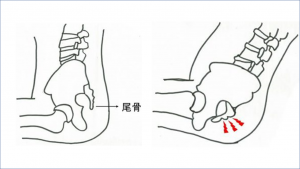 尾てい骨が痛い 6つの原因をチェック 中央カイロプラクティック院 堺